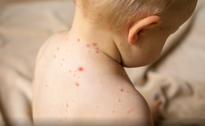 Nivel ziet opvallende stijging waterpokken bij kinderen van 5 tot 14 jaar