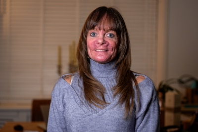 Carola’s gezicht verandert drastisch na zwangerschap: ‘Ze scholden me uit voor konijn’