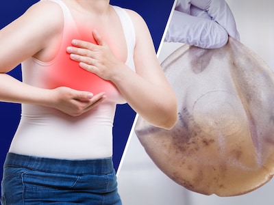 Implantaatbedrijf niet aansprakelijk voor vrouwen die lymfeklierkanker kregen