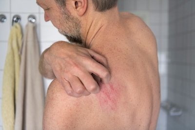 Aantal uitbraken schurft explodeert: mijt nu ook in kinderdagverblijven en verpleeghuizen