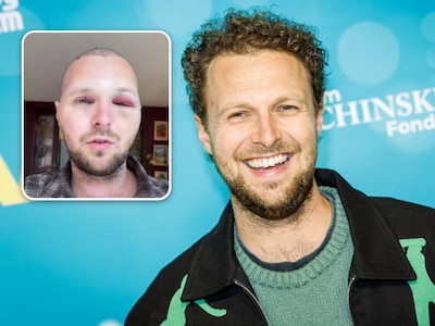 Tim Senders schrikt van opgezwollen gezicht na haartransplantatie: ‘Dit is geen filter’