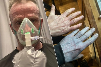 Engelse man schrikt zich rot als hij knalblauw wakker wordt, maar krijgt hilarische ‘diagnose’ in ziekenhuis