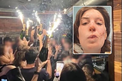 Slachtoffer Zwitserse bar deelt foto’s van haar verbrande gezicht: ‘Gedachten zijn bij alle engelen die het niet haalden’